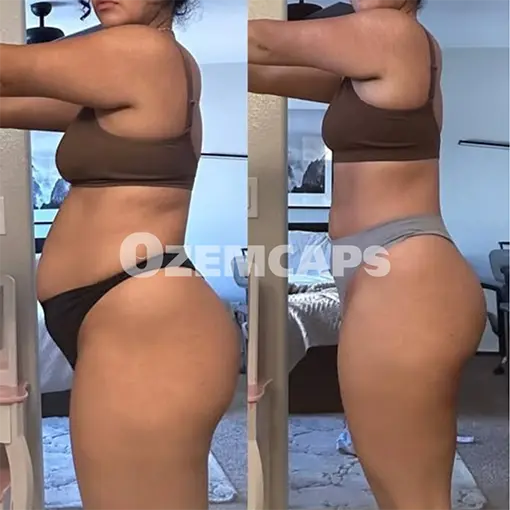 Resultado antes e depois OzemCaps 2