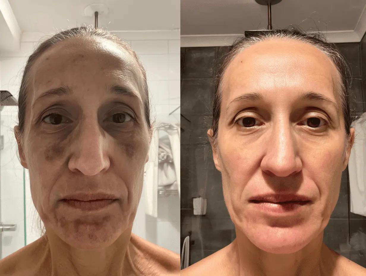 Resultado Purah antes e depois - Jovana