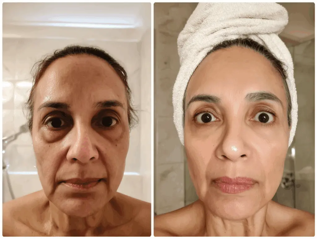 Resultado Purah antes e depois - Valéria