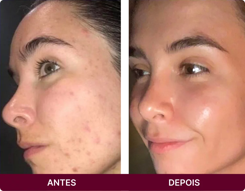 Rosa Amazônica antes e depois no rosto com rugas