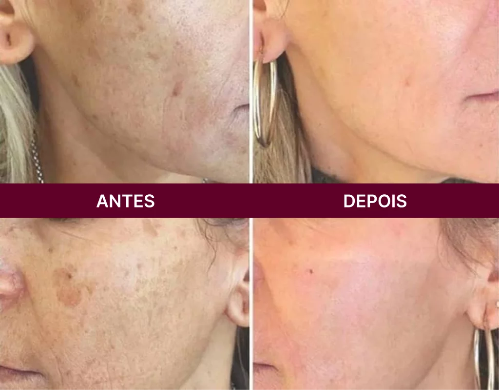 Antes e depois do Sérum Rosa Amazônica em pele com melasma