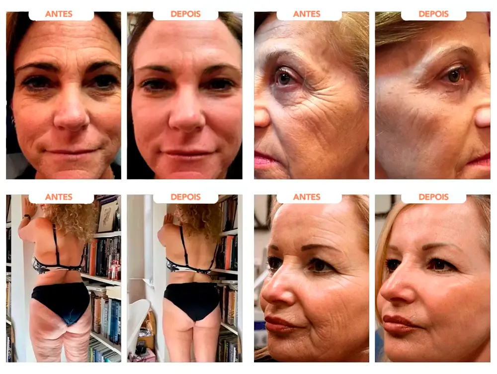 Foto de antes e depois do uso de resveratrol na pele do rosto e no corpo